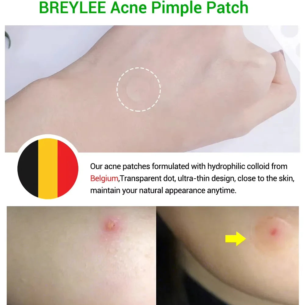22 Patches Invisible Acne Pimple Patch Made with Tea Tree Exact Waterproof & Breathable Acne Pimple Covering Sticker